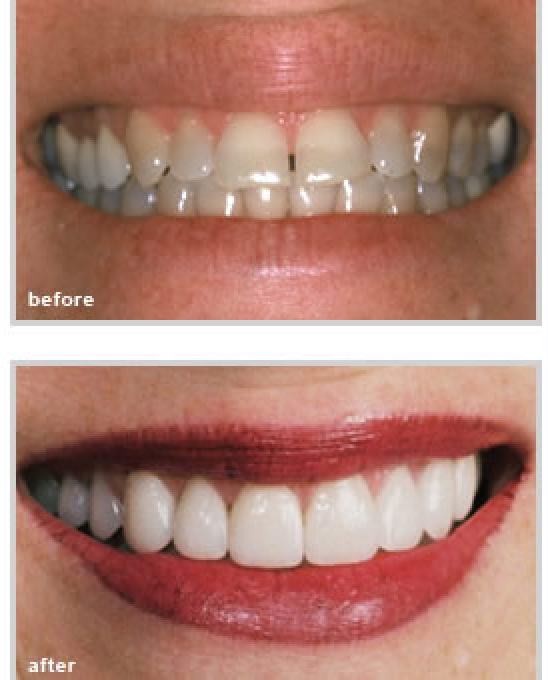before and after dental treatment from our dentist in Fort Worth