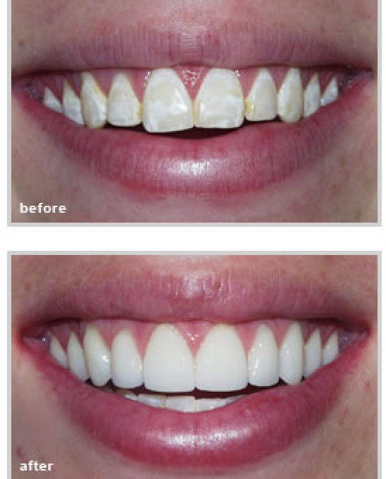 before and after dental treatment from our dentist in Fort Worth