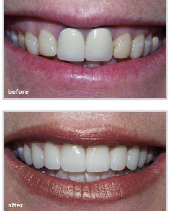 before and after dental treatment from our dentist in Fort Worth