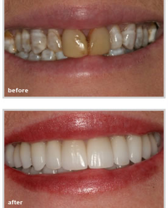 before and after dental treatment from our dentist in Fort Worth