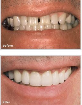 before and after dental treatment from our dentist in Fort Worth