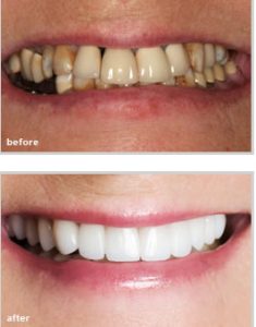 before and after dental treatment from our dentist in Fort Worth