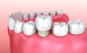 porcelain dental crown