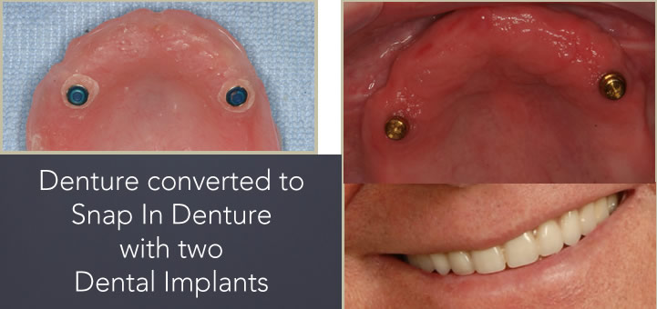 snap in denture