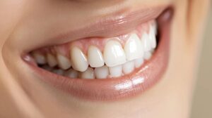 smile makeover