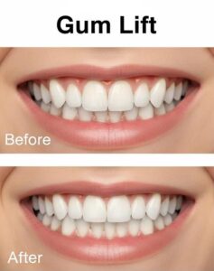 comparison-of-gum-lift-and-gingivectomy-techniques-in-cosmetic-dentistry